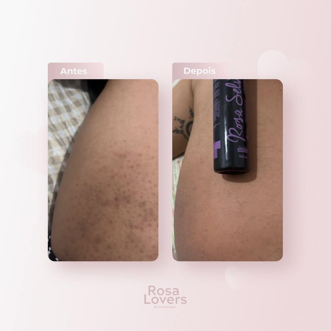 Antes e depois Rosa Selvagem nas pernas