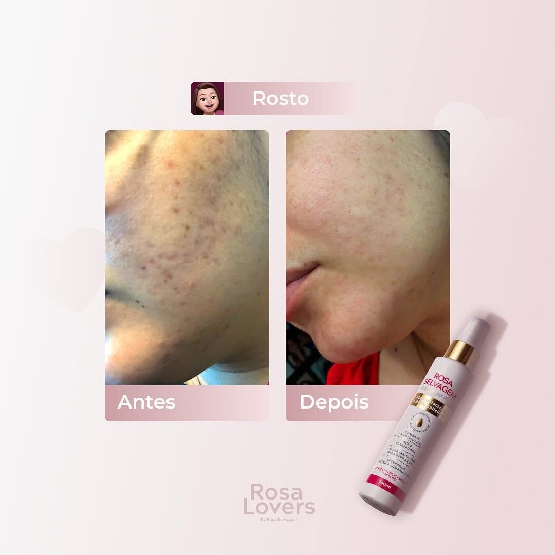 Antes e depois Rosa Selvagem em virilhas